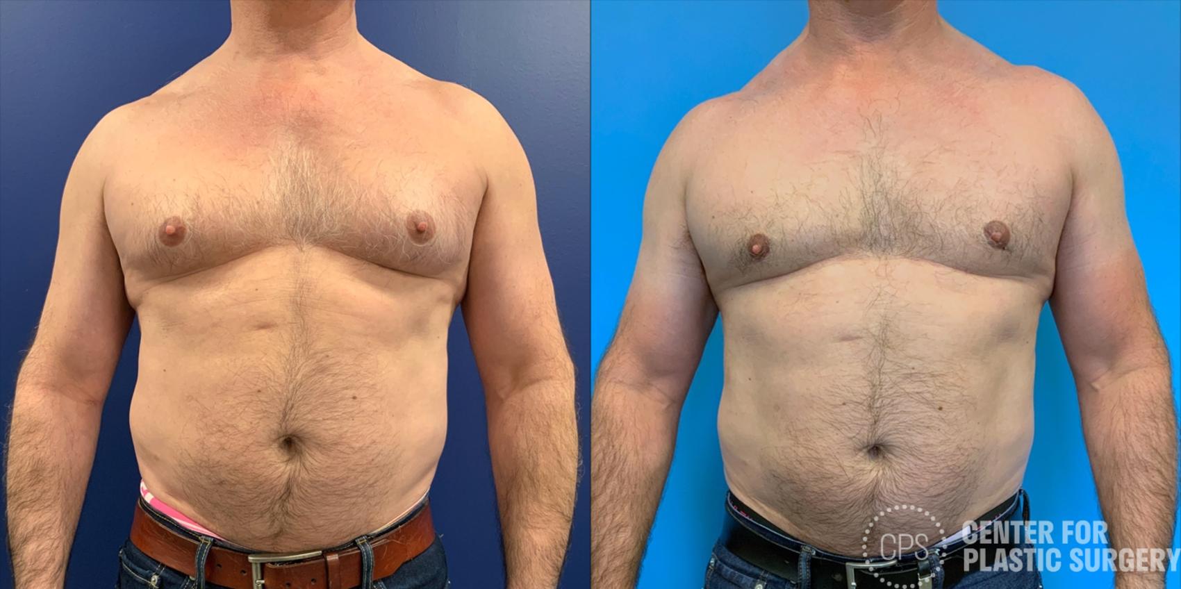 Male Breast Reduction / Gynecomastia Case 210 Before & After Front | Washington, DC, Washington D.C. Metropolitan Area | Center for Plastic Surgery