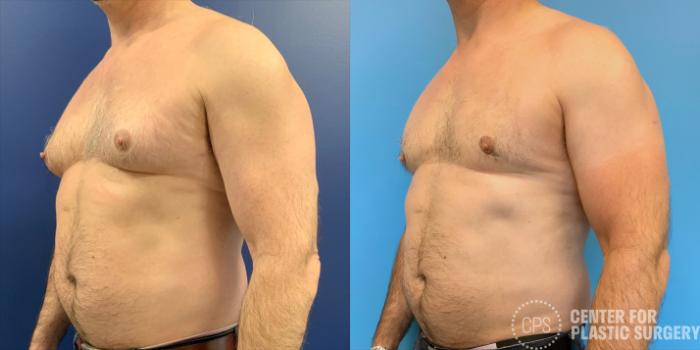 Male Breast Reduction / Gynecomastia Case 210 Before & After Right Oblique | Chevy Chase & Annandale, Washington D.C. Metropolitan Area | Center for Plastic Surgery