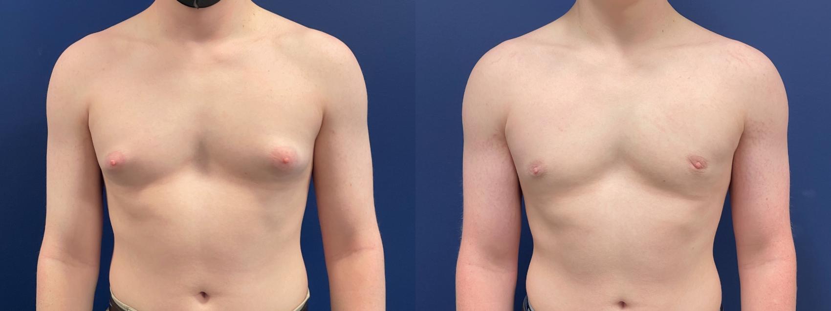 Male Breast Reduction / Gynecomastia Case 214 Before & After Front | Chevy Chase & Annandale, Washington D.C. Metropolitan Area | Center for Plastic Surgery