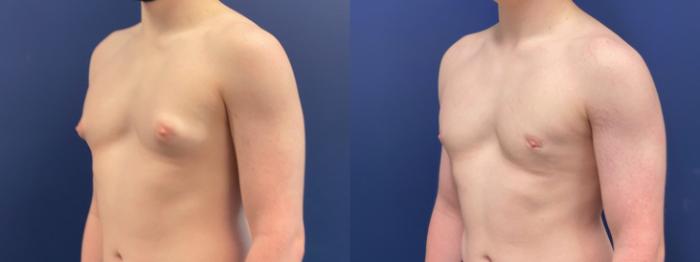 Male Breast Reduction / Gynecomastia Case 214 Before & After Left Oblique | Chevy Chase & Annandale, Washington D.C. Metropolitan Area | Center for Plastic Surgery