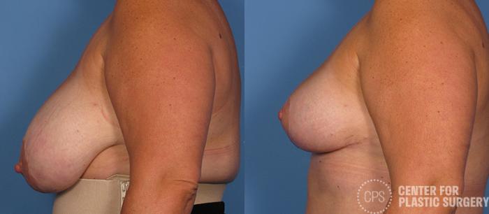 Breast Reduction Case 129 Before & After Left Side | Chevy Chase & Annandale, Washington D.C. Metropolitan Area | Center for Plastic Surgery