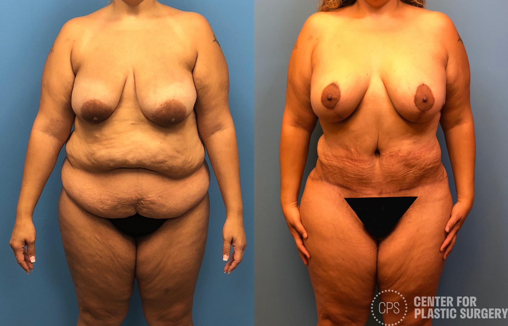 Tummy Tuck Case 179 Before & After Front | Chevy Chase & Annandale, Washington D.C. Metropolitan Area | Center for Plastic Surgery