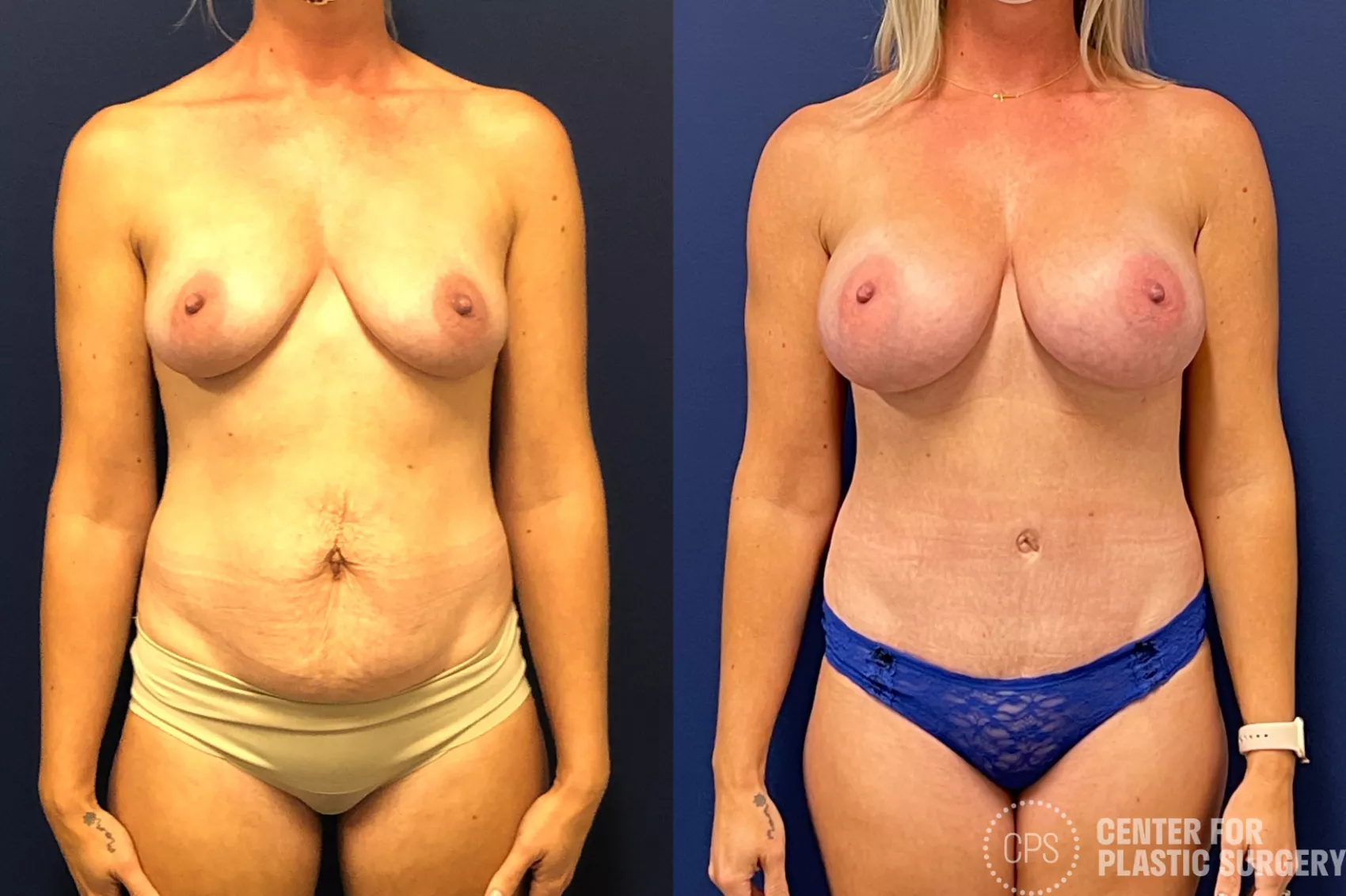 Mommy Makeover Case 205 Before & After Front | Annandale, Washington D.C. Metropolitan Area | Center for Plastic Surgery