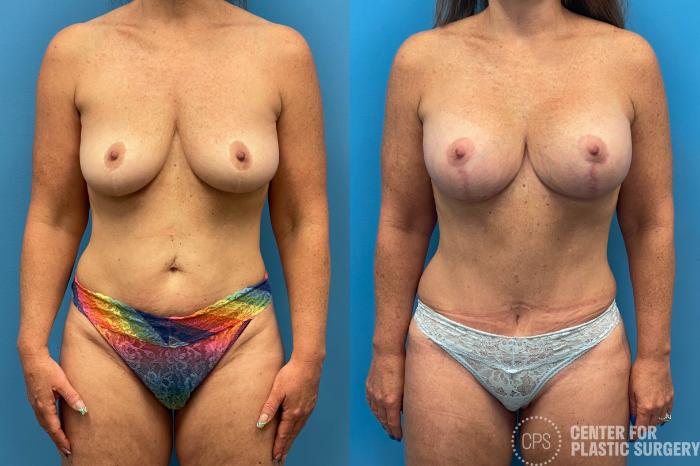 Tummy Tuck Case 216 Before & After Front | Chevy Chase & Annandale, Washington D.C. Metropolitan Area | Center for Plastic Surgery