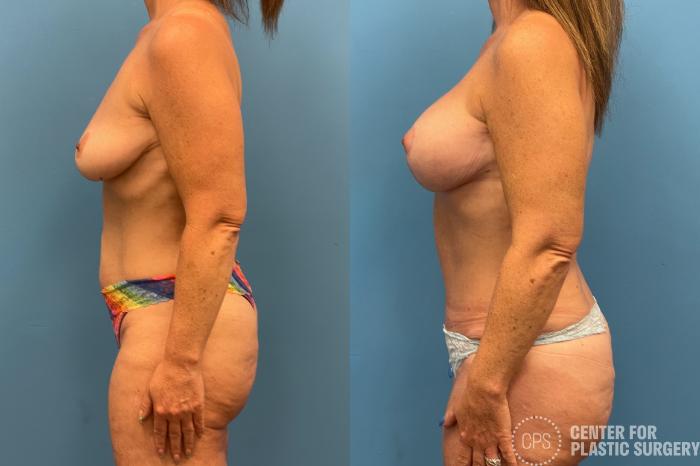 Tummy Tuck Case 216 Before & After Left Side | Chevy Chase & Annandale, Washington D.C. Metropolitan Area | Center for Plastic Surgery