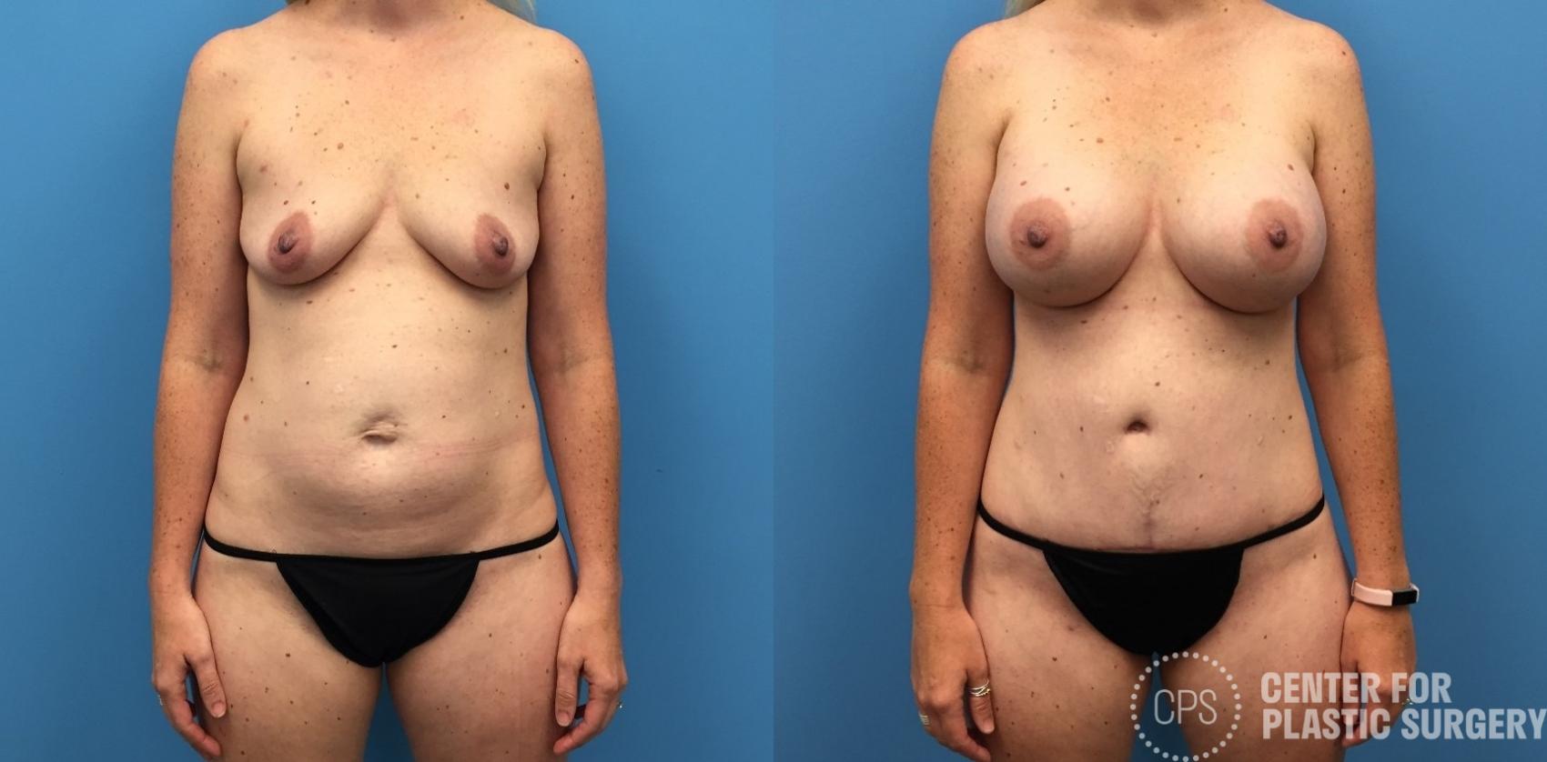 Tummy Tuck Case 261 Before & After Front | Chevy Chase & Annandale, Washington D.C. Metropolitan Area | Center for Plastic Surgery