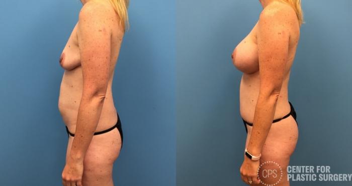 Breast Augmentation Case 261 Before & After Left Side | Chevy Chase & Annandale, Washington D.C. Metropolitan Area | Center for Plastic Surgery