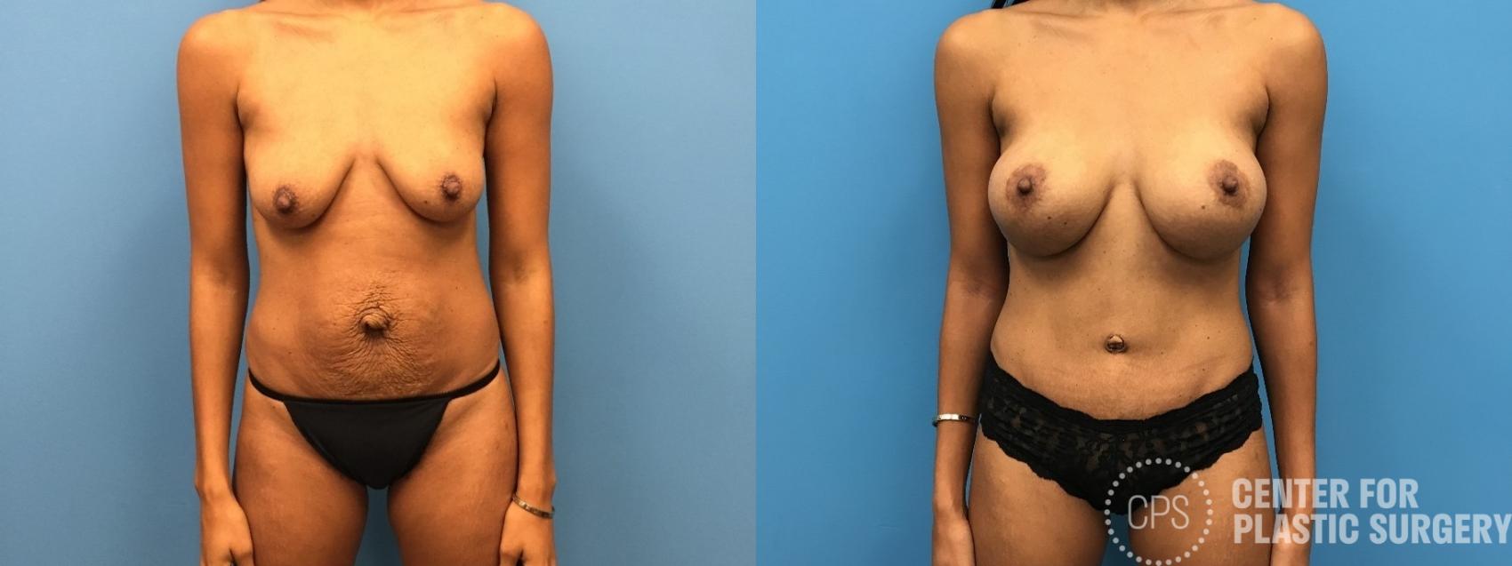 Breast Augmentation Case 262 Before & After Front | Chevy Chase & Annandale, Washington D.C. Metropolitan Area | Center for Plastic Surgery