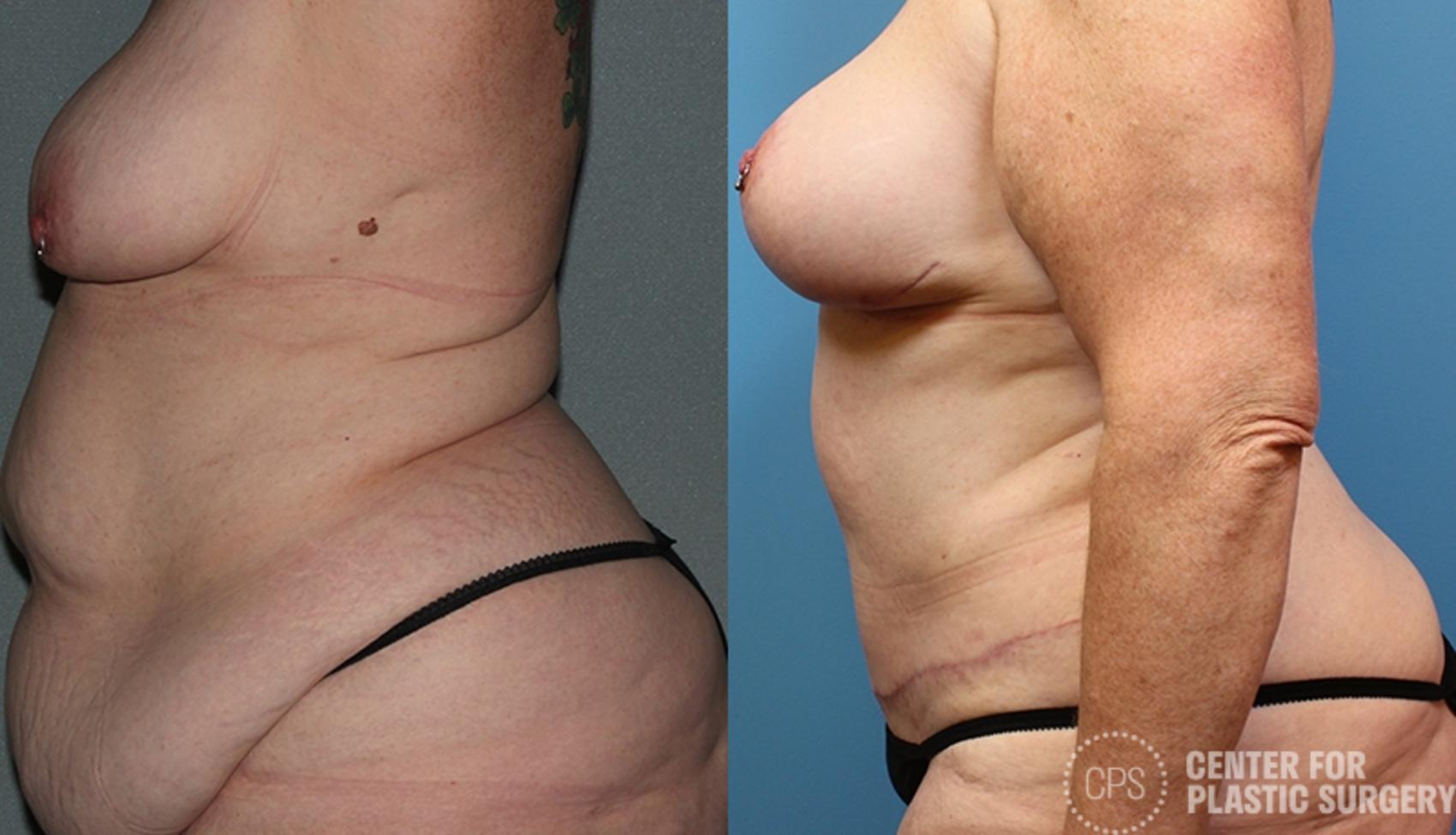 Mommy Makeover Case 38 Before & After Left Side | Annandale, Washington D.C. Metropolitan Area | Center for Plastic Surgery