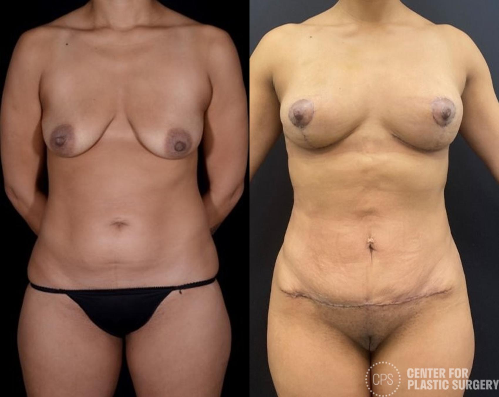 Breast Augmentation with Lift Case 384 Before & After Front | Chevy Chase & Annandale, Washington D.C. Metropolitan Area | Center for Plastic Surgery