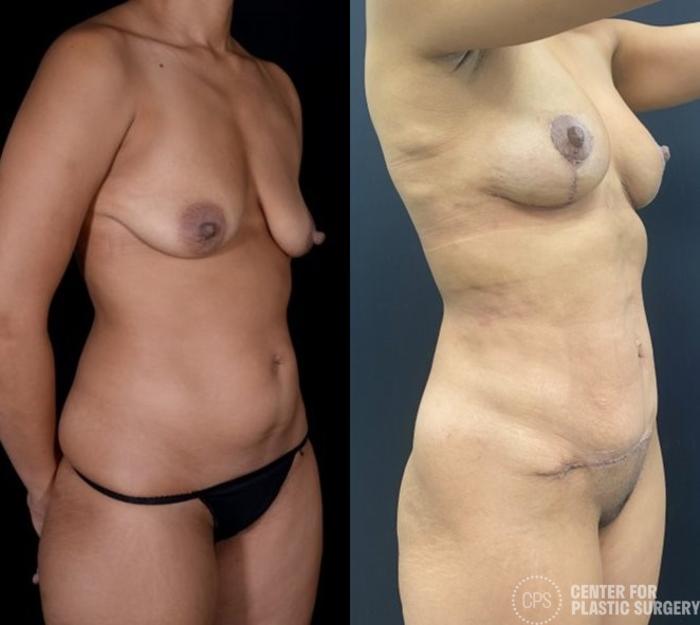 Mommy Makeover Case 384 Before & After Right Oblique | Chevy Chase & Annandale, Washington D.C. Metropolitan Area | Center for Plastic Surgery