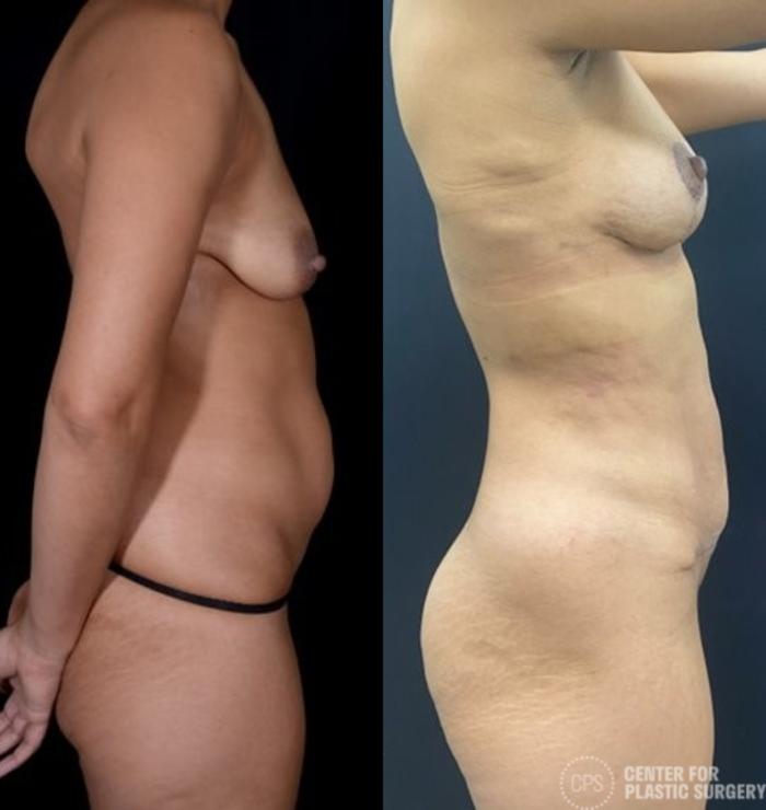 Tummy Tuck Case 384 Before & After Right Side | Chevy Chase & Annandale, Washington D.C. Metropolitan Area | Center for Plastic Surgery