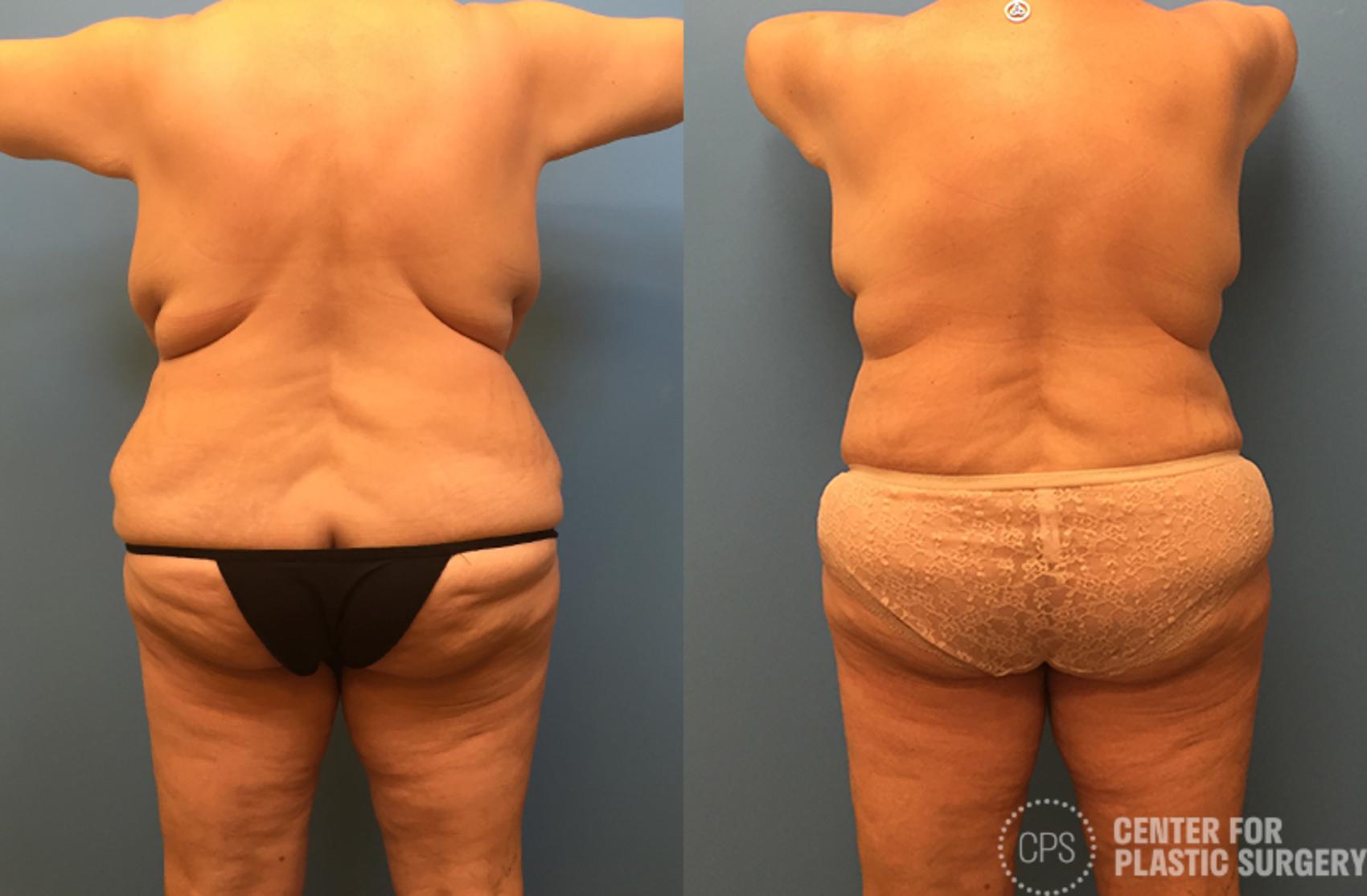 Mommy Makeover Case 39 Before & After Back | Annandale, Washington D.C. Metropolitan Area | Center for Plastic Surgery