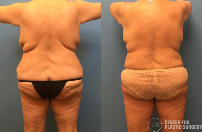 Liposuction Case 39 Before & After Back | Chevy Chase & Annandale, Washington D.C. Metropolitan Area | Center for Plastic Surgery