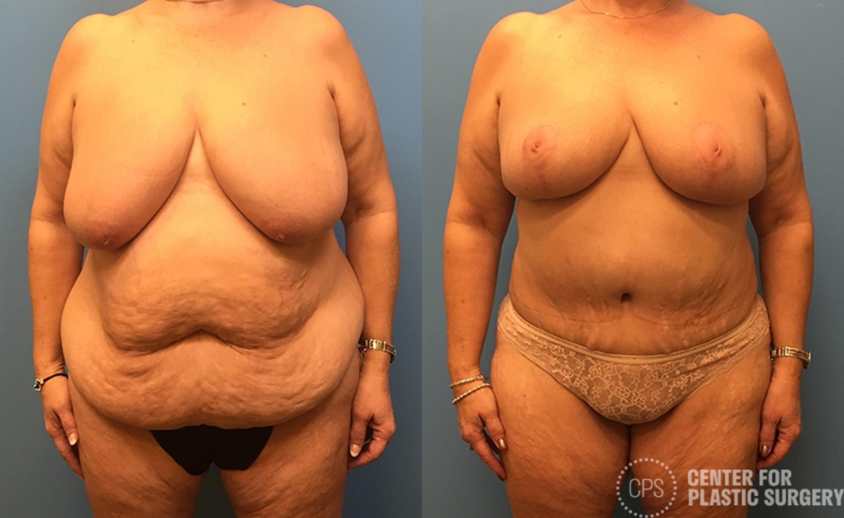 Mommy Makeover Case 39 Before & After Front | Annandale, Washington D.C. Metropolitan Area | Center for Plastic Surgery