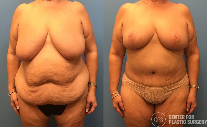 Tummy Tuck Case 39 Before & After Front | Chevy Chase & Annandale, Washington D.C. Metropolitan Area | Center for Plastic Surgery