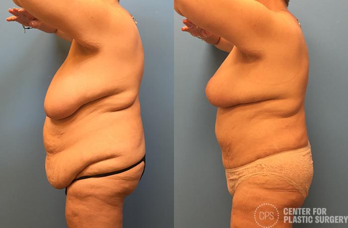 Tummy Tuck Case 39 Before & After Left Oblique | Chevy Chase & Annandale, Washington D.C. Metropolitan Area | Center for Plastic Surgery