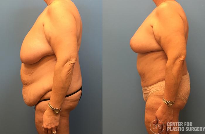 Tummy Tuck Case 39 Before & After Left Side | Chevy Chase & Annandale, Washington D.C. Metropolitan Area | Center for Plastic Surgery