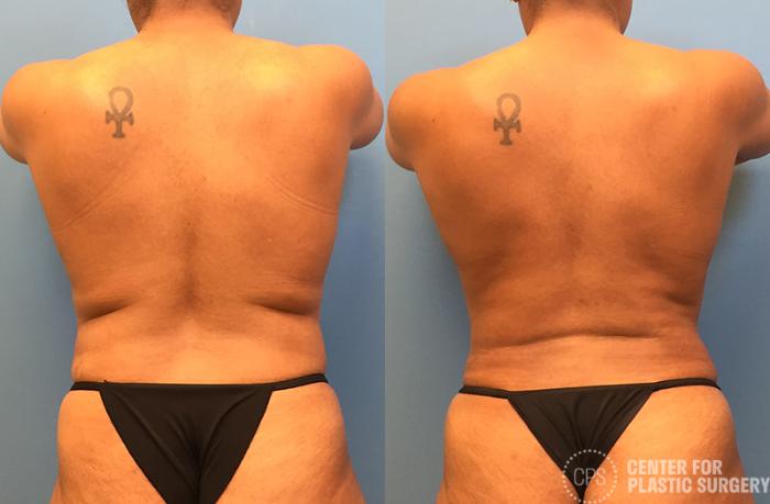 Tummy Tuck Case 40 Before & After Back | Chevy Chase & Annandale, Washington D.C. Metropolitan Area | Center for Plastic Surgery