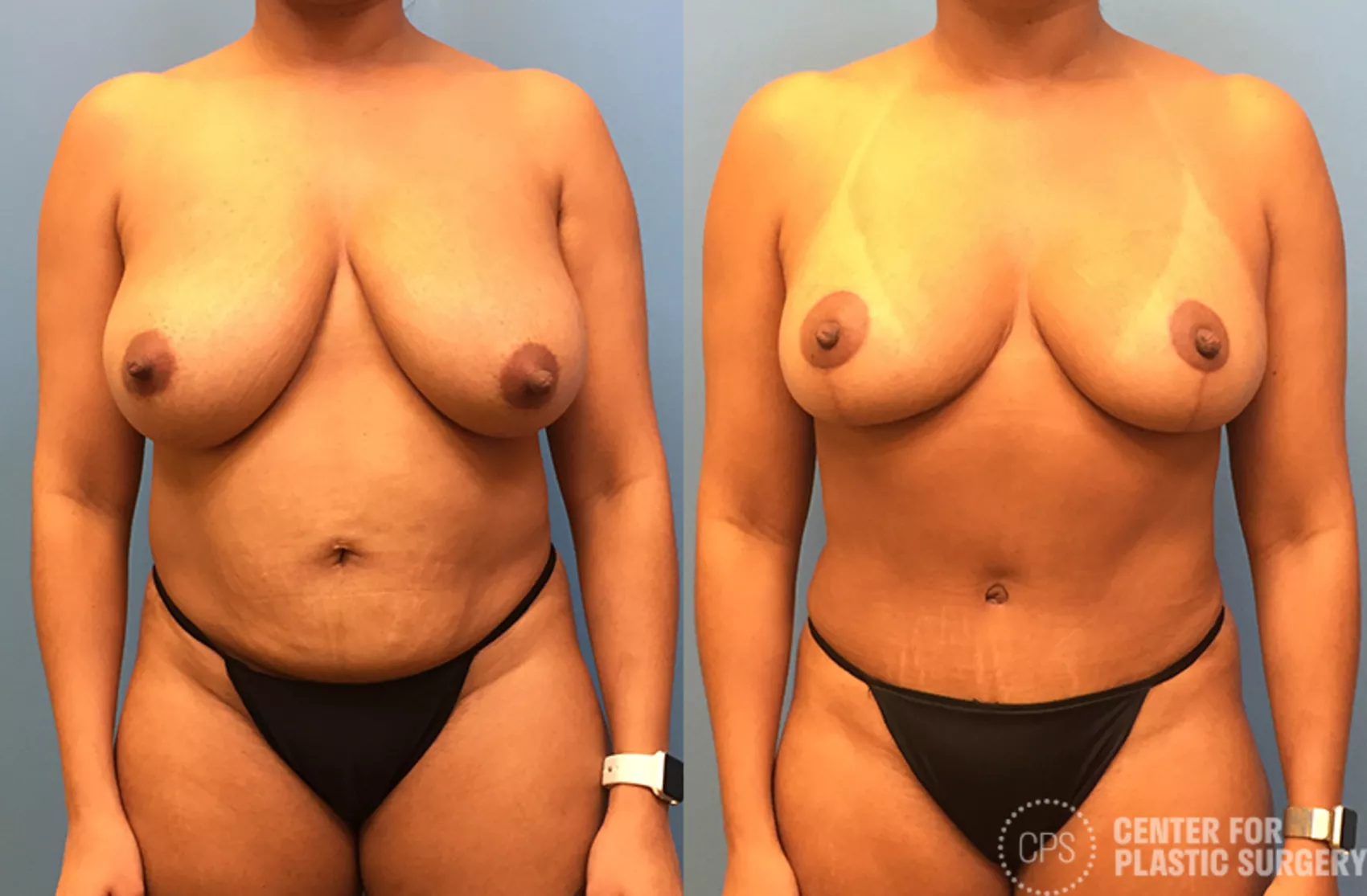 Mommy Makeover Case 40 Before & After Front | Annandale, Washington D.C. Metropolitan Area | Center for Plastic Surgery