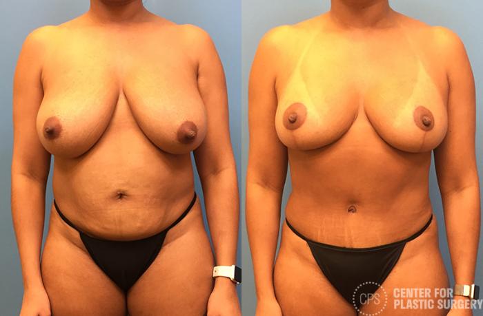 Tummy Tuck Case 40 Before & After Front | Chevy Chase & Annandale, Washington D.C. Metropolitan Area | Center for Plastic Surgery