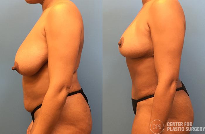Breast Reduction Case 40 Before & After Left Side | Chevy Chase & Annandale, Washington D.C. Metropolitan Area | Center for Plastic Surgery