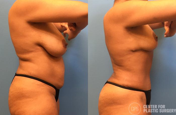Breast Reduction Case 40 Before & After Right Side | Chevy Chase & Annandale, Washington D.C. Metropolitan Area | Center for Plastic Surgery