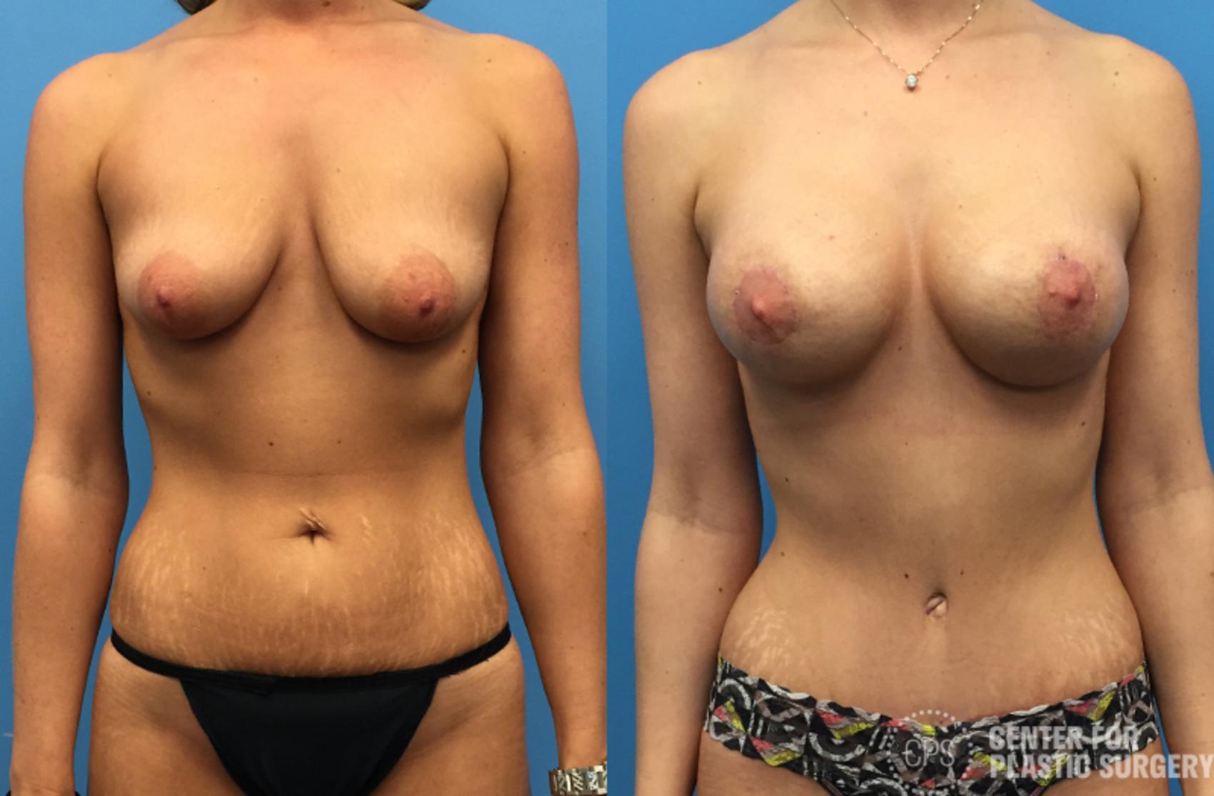 Mommy Makeover Case 41 Before & After Front | Annandale, Washington D.C. Metropolitan Area | Center for Plastic Surgery