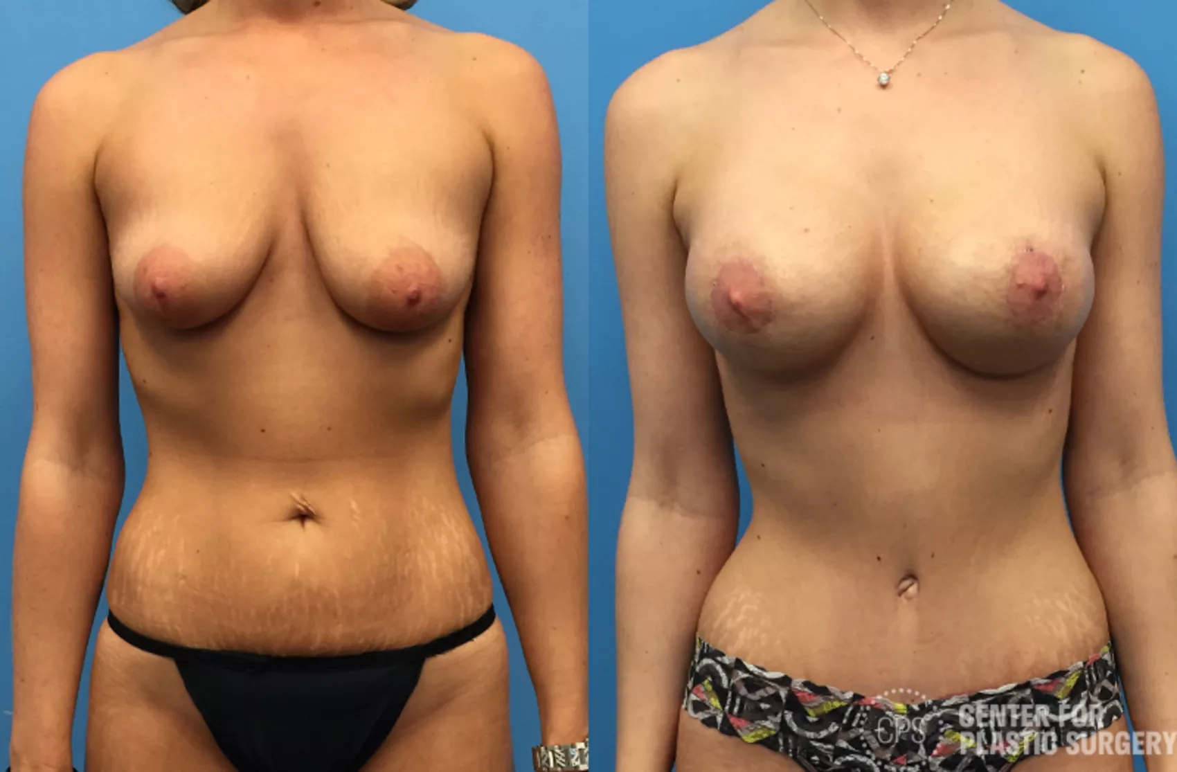 Mommy Makeover Case 41 Before & After Front | Annandale, Washington D.C. Metropolitan Area | Center for Plastic Surgery