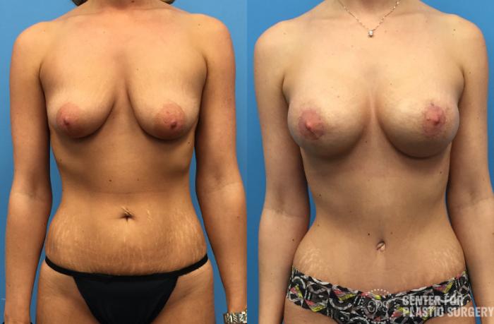 Tummy Tuck Case 41 Before & After Front | Chevy Chase & Annandale, Washington D.C. Metropolitan Area | Center for Plastic Surgery