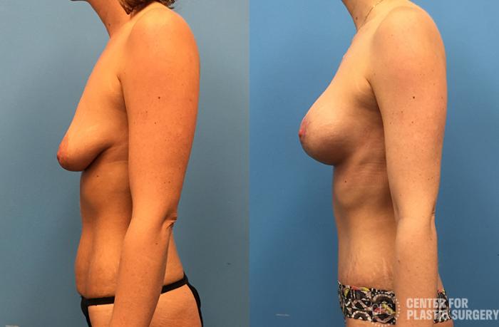 Breast Augmentation with Lift Case 41 Before & After Left Side | Chevy Chase & Annandale, Washington D.C. Metropolitan Area | Center for Plastic Surgery