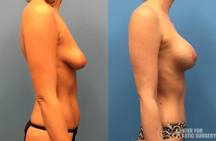 Tummy Tuck Case 41 Before & After Right Side | Chevy Chase & Annandale, Washington D.C. Metropolitan Area | Center for Plastic Surgery
