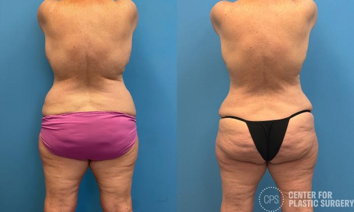 Liposuction Case 438 Before & After Back | Chevy Chase & Annandale, Washington D.C. Metropolitan Area | Center for Plastic Surgery