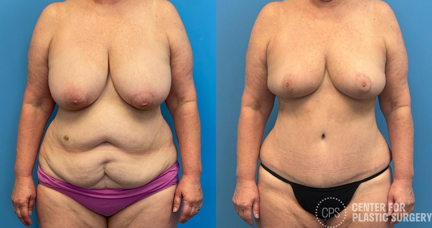 Breast Reduction Case 438 Before & After Front | Chevy Chase & Annandale, Washington D.C. Metropolitan Area | Center for Plastic Surgery