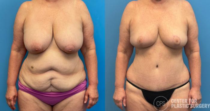 Tummy Tuck Case 438 Before & After Front | Chevy Chase & Annandale, Washington D.C. Metropolitan Area | Center for Plastic Surgery