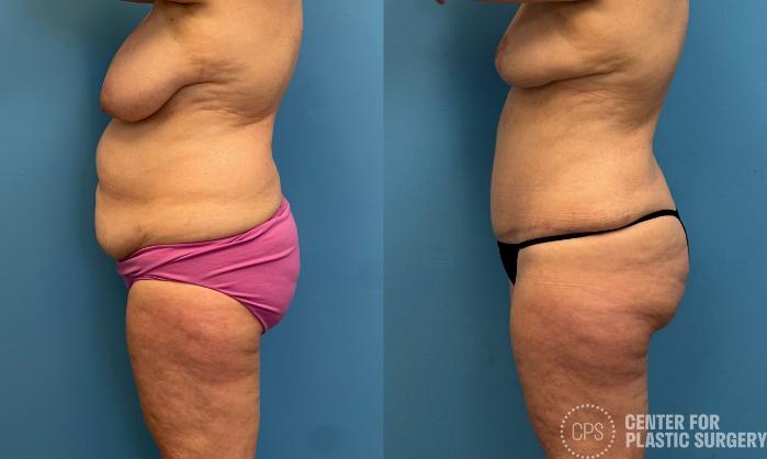Tummy Tuck Case 438 Before & After Left Side | Chevy Chase & Annandale, Washington D.C. Metropolitan Area | Center for Plastic Surgery