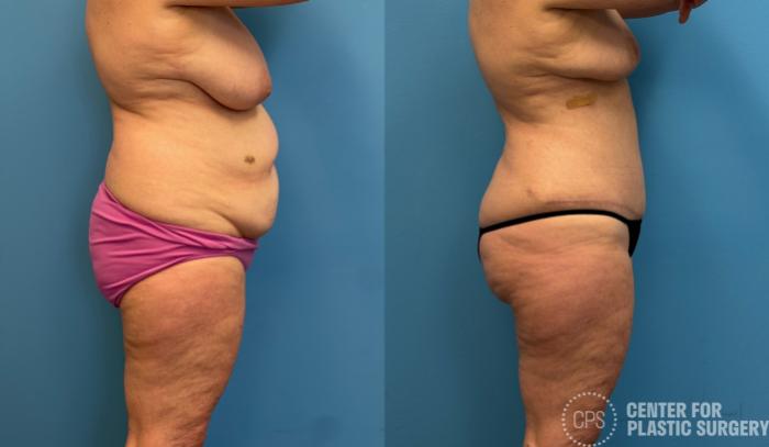 Liposuction Case 438 Before & After Right Side | Chevy Chase & Annandale, Washington D.C. Metropolitan Area | Center for Plastic Surgery
