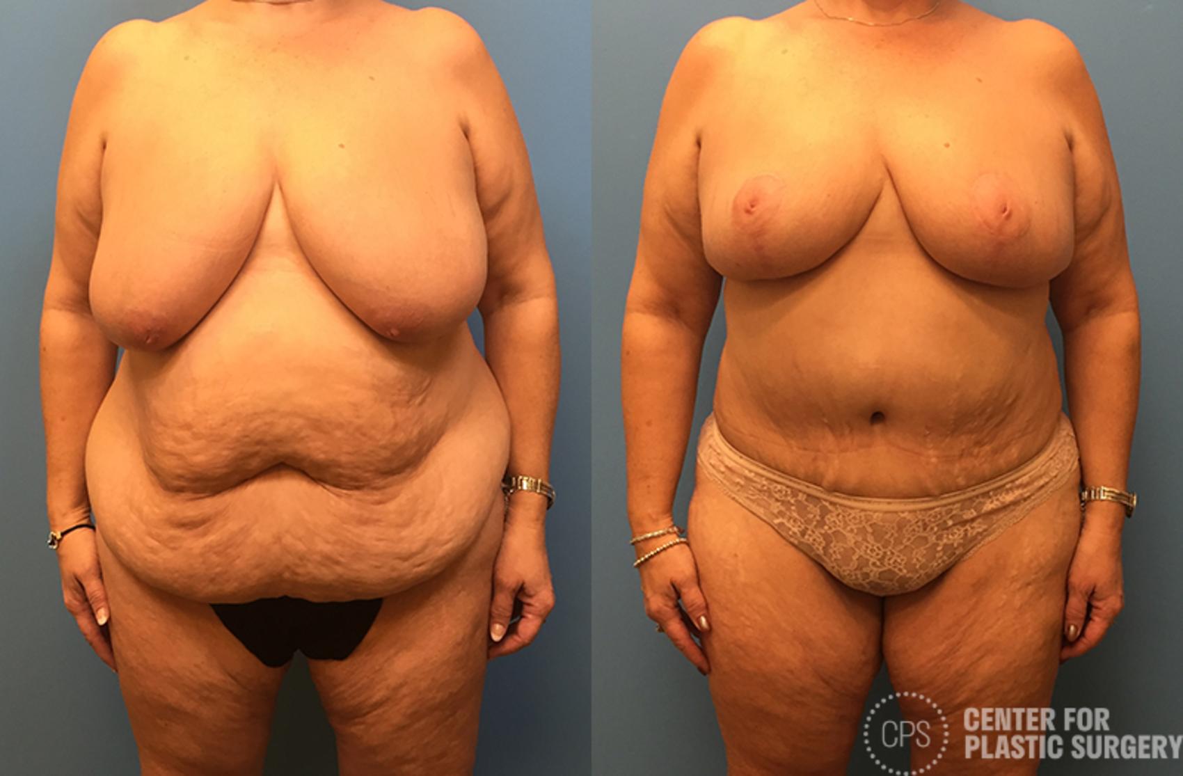 Mommy Makeover Case 62 Before & After Front | Annandale, Washington D.C. Metropolitan Area | Center for Plastic Surgery