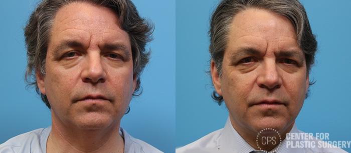 Neck Lift Case 30 Before & After Front | Chevy Chase & Annandale, Washington D.C. Metropolitan Area | Center for Plastic Surgery