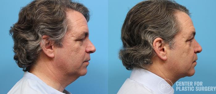 Neck Lift Case 30 Before & After Right Side | Chevy Chase & Annandale, Washington D.C. Metropolitan Area | Center for Plastic Surgery