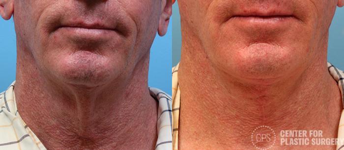 Facelift for Men Case 31 Before & After Front | Chevy Chase & Annandale, Washington D.C. Metropolitan Area | Center for Plastic Surgery