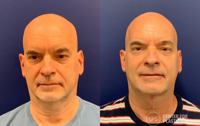 Neck Lift Case 333 Before & After Front | Chevy Chase & Annandale, Washington D.C. Metropolitan Area | Center for Plastic Surgery