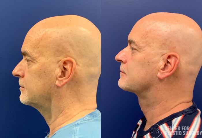 Neck Lift Case 333 Before & After Left Side | Chevy Chase & Annandale, Washington D.C. Metropolitan Area | Center for Plastic Surgery