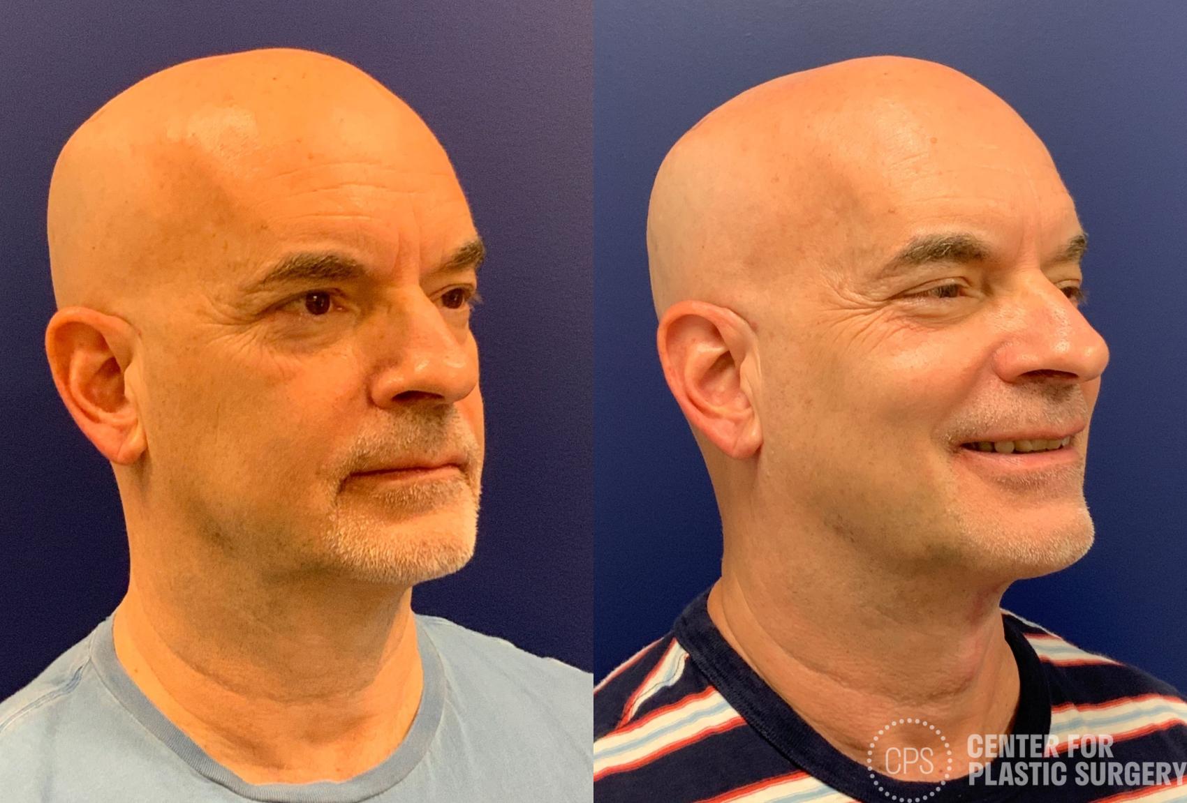 Necklift Before & After Photos of Patient at The Center for Plastic