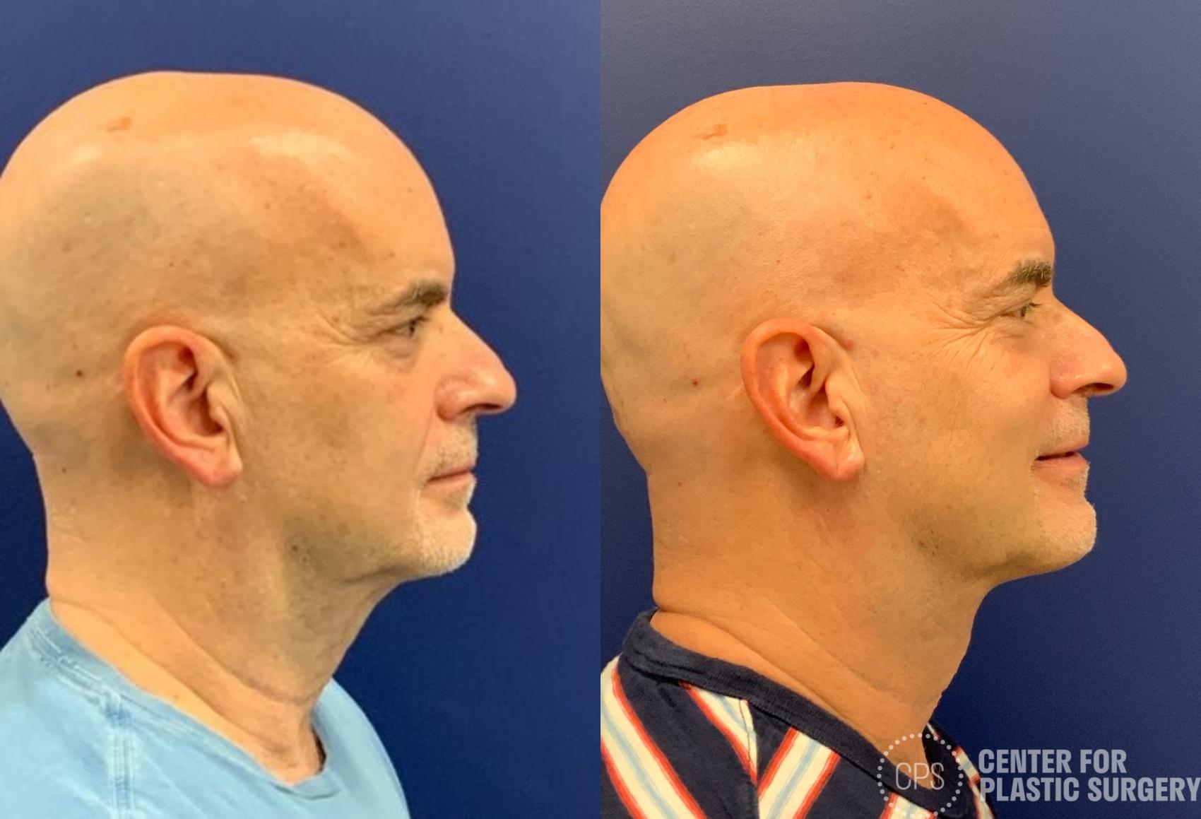 Necklift Before & After Photos of Patient at The Center for Plastic ...