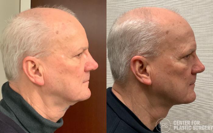 Neck Lift Case 406 Before & After Right Side | Chevy Chase & Annandale, Washington D.C. Metropolitan Area | Center for Plastic Surgery