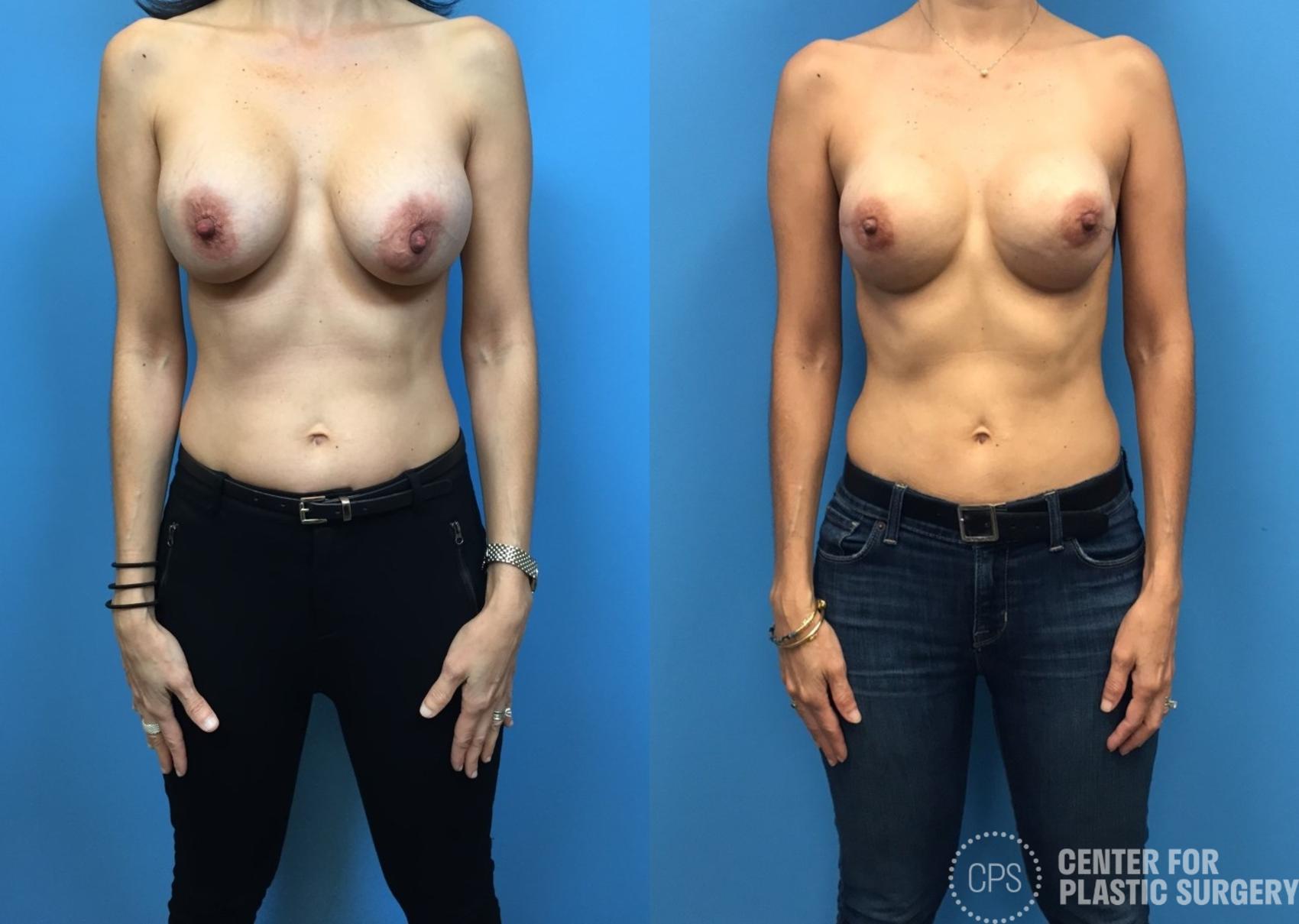 Nipple Reconstruction Case 304 Before & After Front | Washington, DC, Washington D.C. Metropolitan Area | Center for Plastic Surgery