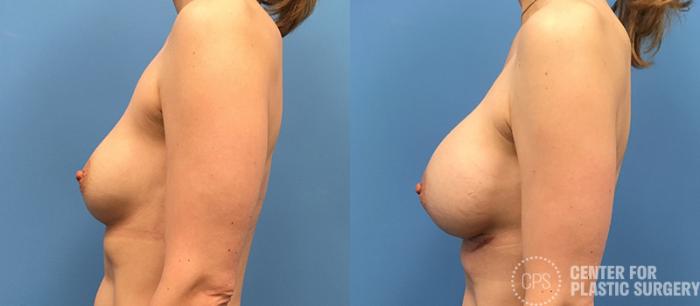 Revision Augmentation Case 117 Before & After Left Side | Chevy Chase & Annandale, Washington D.C. Metropolitan Area | Center for Plastic Surgery