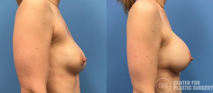 Revision Augmentation Case 117 Before & After Right Side | Chevy Chase & Annandale, Washington D.C. Metropolitan Area | Center for Plastic Surgery