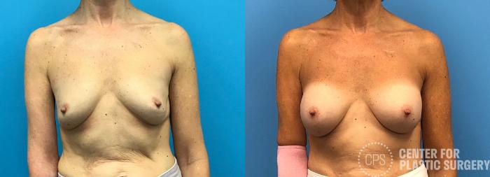 Revision Augmentation Case 175 Before & After Front | Chevy Chase & Annandale, Washington D.C. Metropolitan Area | Center for Plastic Surgery